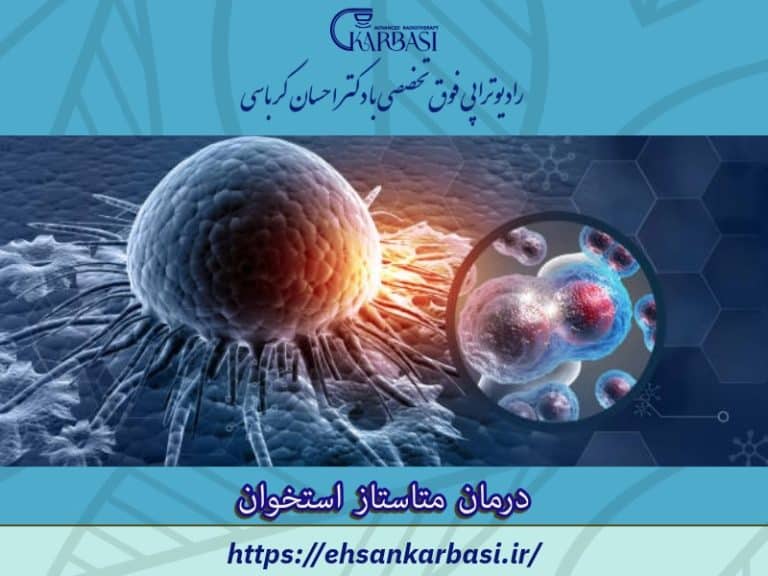 درمان متاستاز استخوان 2 درمان متاستاز استخوان
