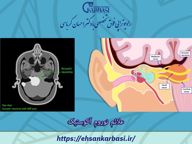 علائم نوروم آکوستیک