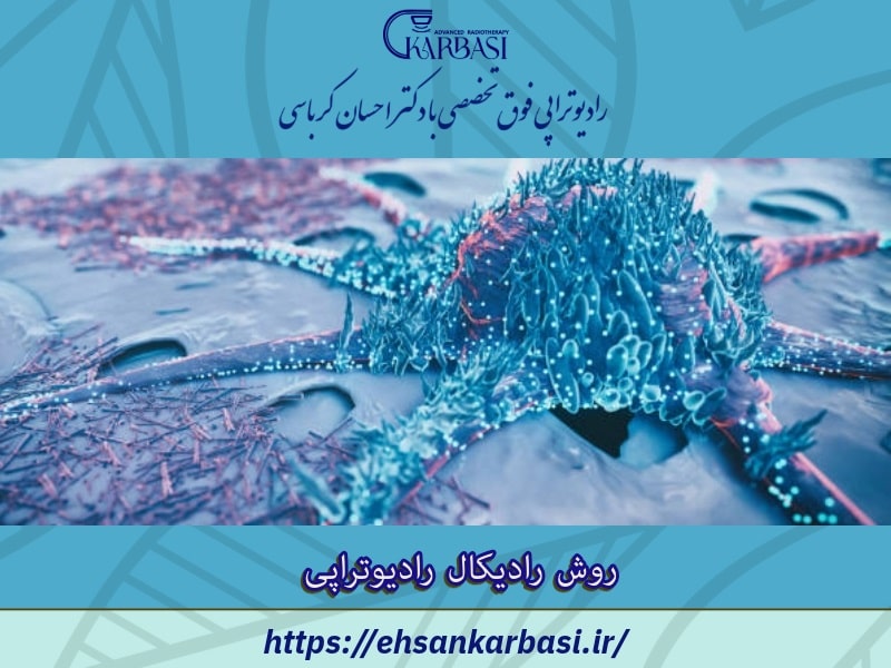 روش رادیکال رادیوتراپی