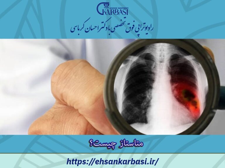 متاستاز یا سرطان متاستاتیک چیست؟ + درمان 2 متاستاز یا سرطان متاستاتیک چیست؟