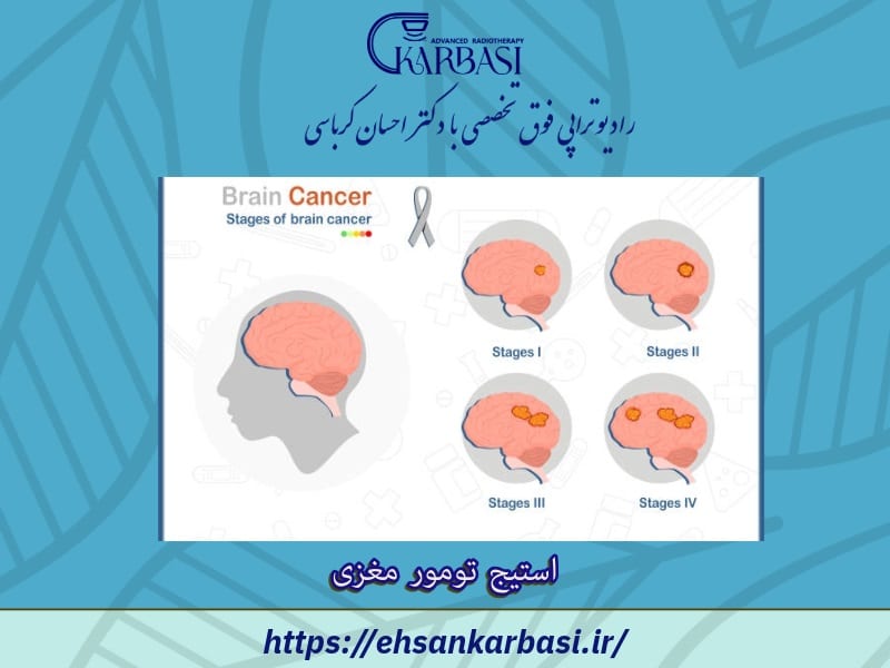 استیج تومور مغزی