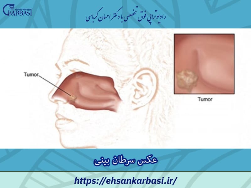 عکس سرطان بینی