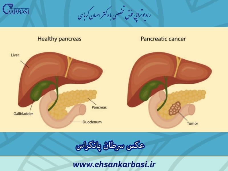 عکس سرطان پانکراس