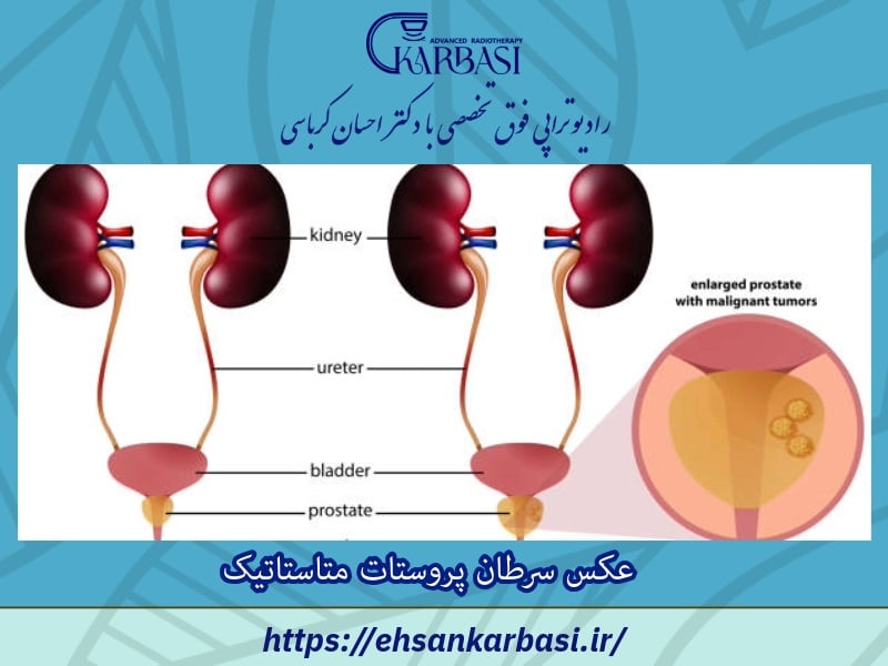 عکس سرطان پروستات متاستاتیک