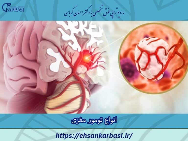انواع تومور مغزی 2 انواع تومور مغزی