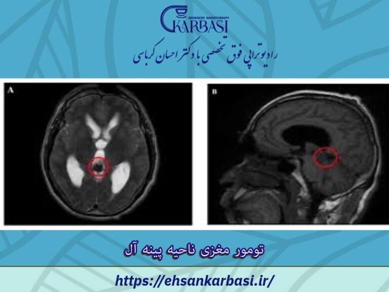 تومور مغزی پینه آل 2 تومور مغزی پینه آل
