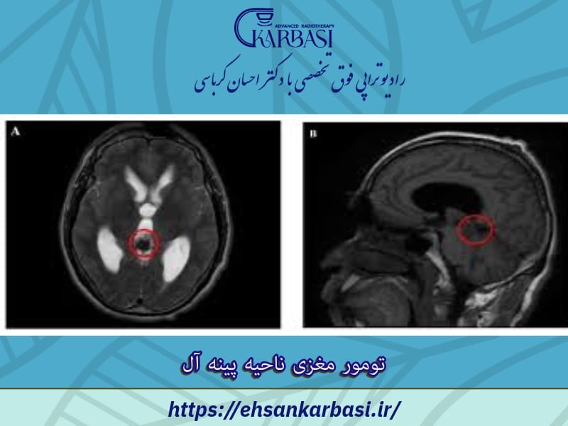 تومور مغزی پینه آل