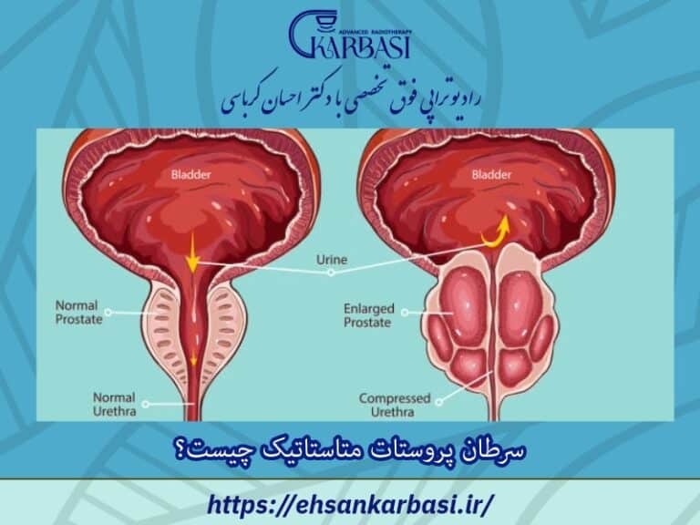سرطان پروستات متاستاتیک چیست؟ 2 سرطان پروستات متاستاتیک چیست؟