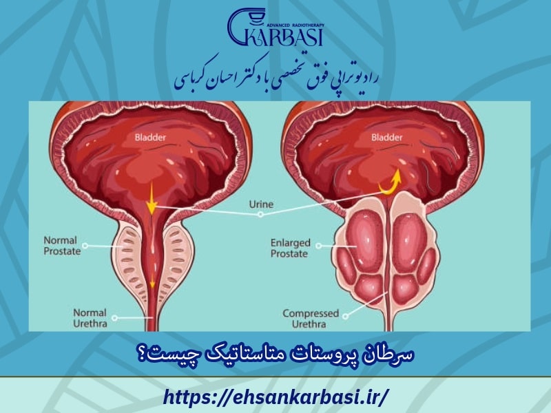 سرطان پروستات متاستاتیک چیست؟