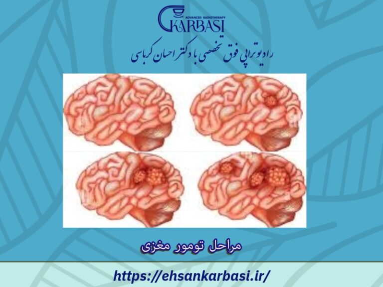 مراحل تومور مغزی 2 مراحل تومور مغزی
