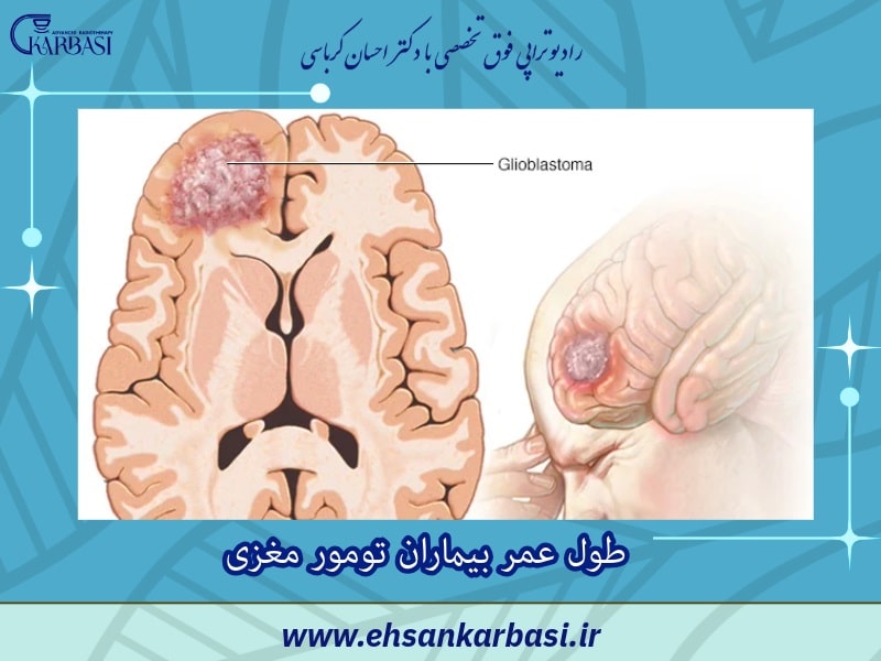 طول عمر بیماران تومور مغزی