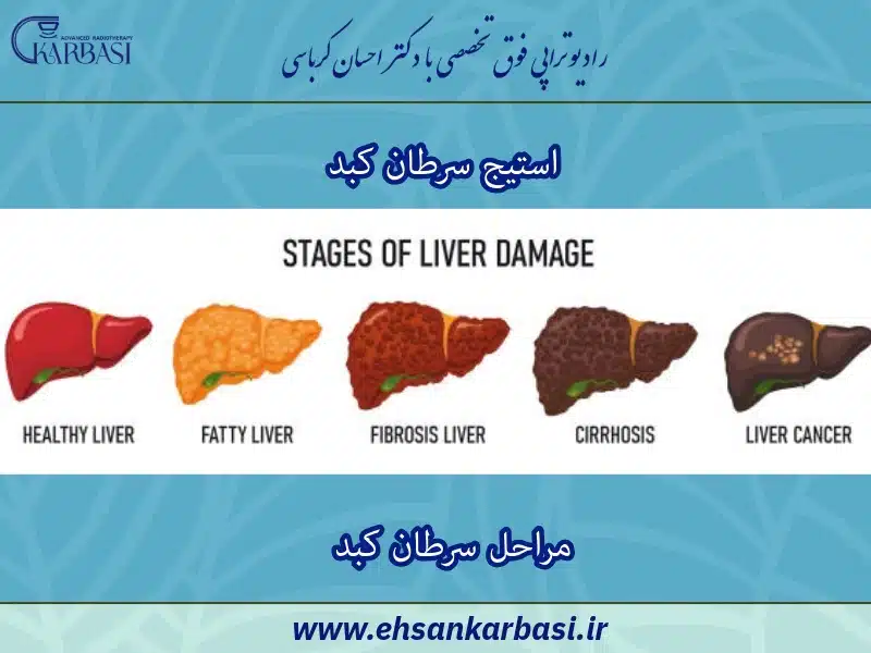 مراحل سرطان کبد