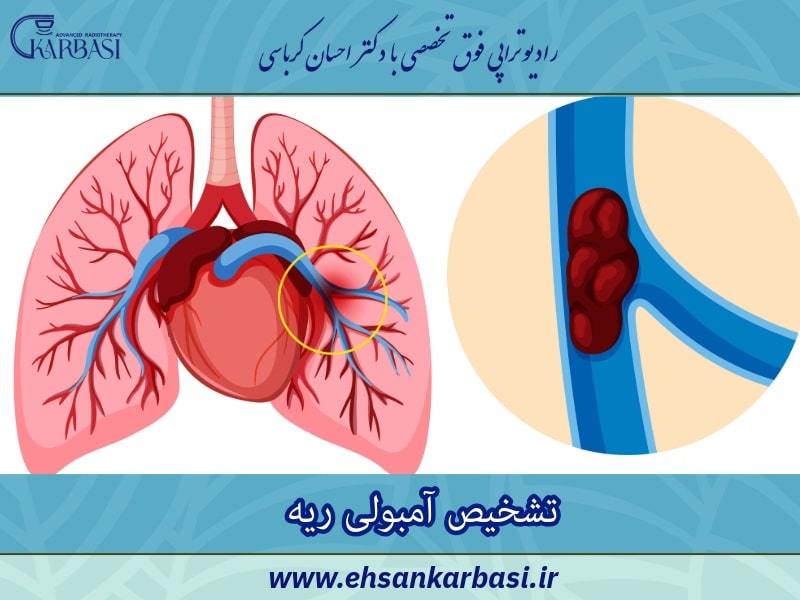 تشخیص آمبولی ریه