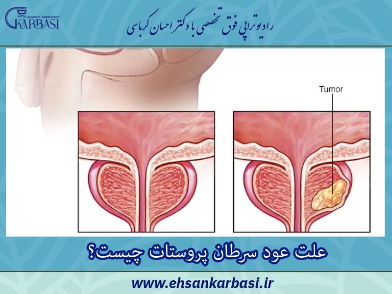 عود سرطان پروستات؛ علائم و درمان 4 علت عود سرطان پروستات چیست؟