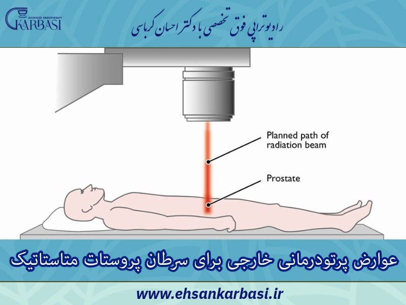پرتو درمانی خارجی سرطان پروستات متاستاتیک 4 عوارض پرتودرمانی خارجی برای سرطان پروستات متاستاتیک