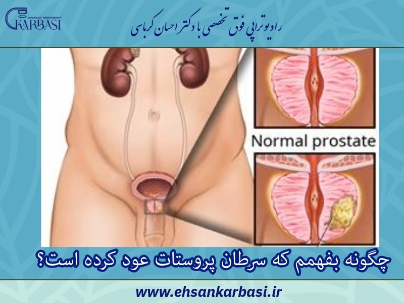 عود سرطان پروستات؛ علائم و درمان 3 چگونه بفهمم که سرطان پروستات عود کرده است؟