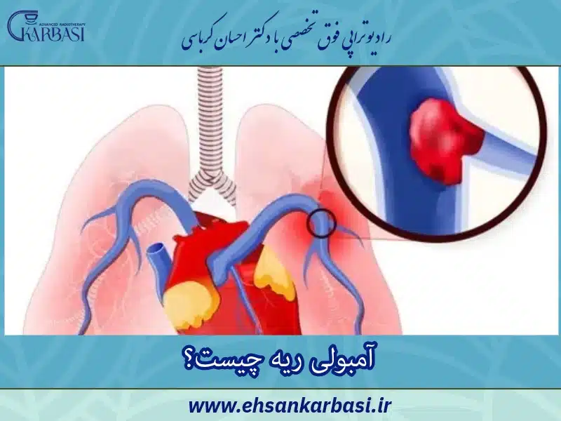 آمبولی ریه چیست؟