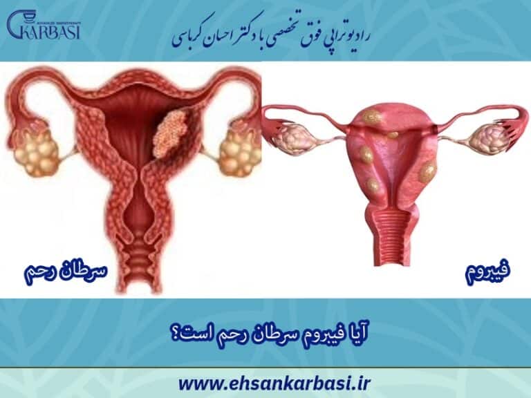 آیا فیبروم رحم سرطان است؟ پاسخ علمی و دقیق 2 آیا فیبروم رحم سرطان است