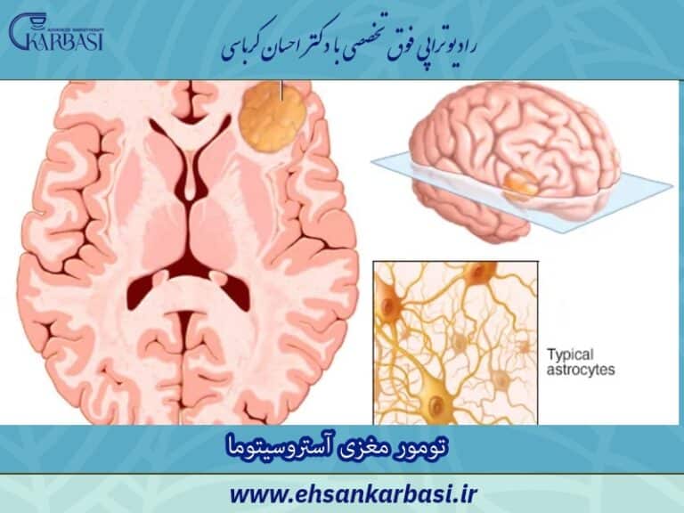 تومور مغزی آستروسیتوما چیست؟ علائم، درمان و امید به زندگی! 2 تومور مغزی آستروسیتوما