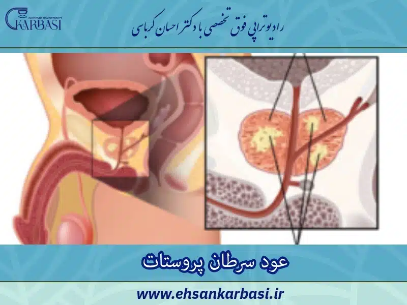 عود سرطان پروستات چیست؟